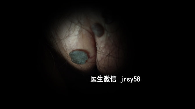 男性尖銳濕疣的自我治療指南，男性尖銳濕疣自我治療指南，實(shí)用方法與技巧