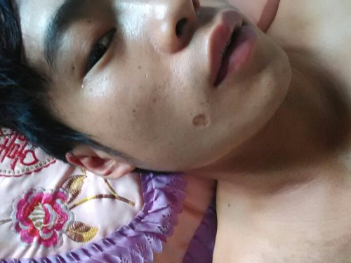 除疤費用一般多少錢——全面解析除疤費用因素與價格范圍，全面解析，除疤費用因素與價格范圍，了解除疤需要多少錢？