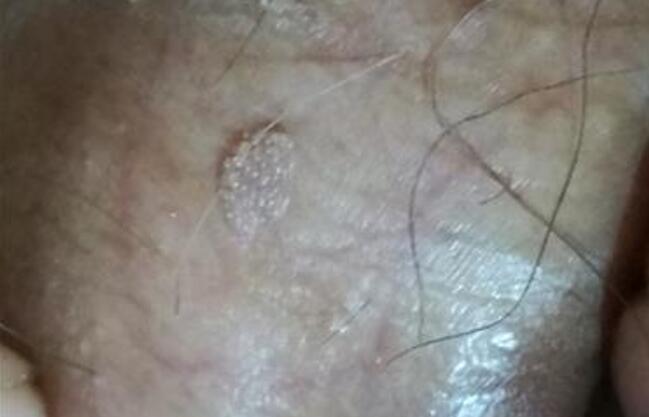 珍珠疹的十種癥狀圖片及其重要性，珍珠疹的十種癥狀圖片詳解及其重要性探討