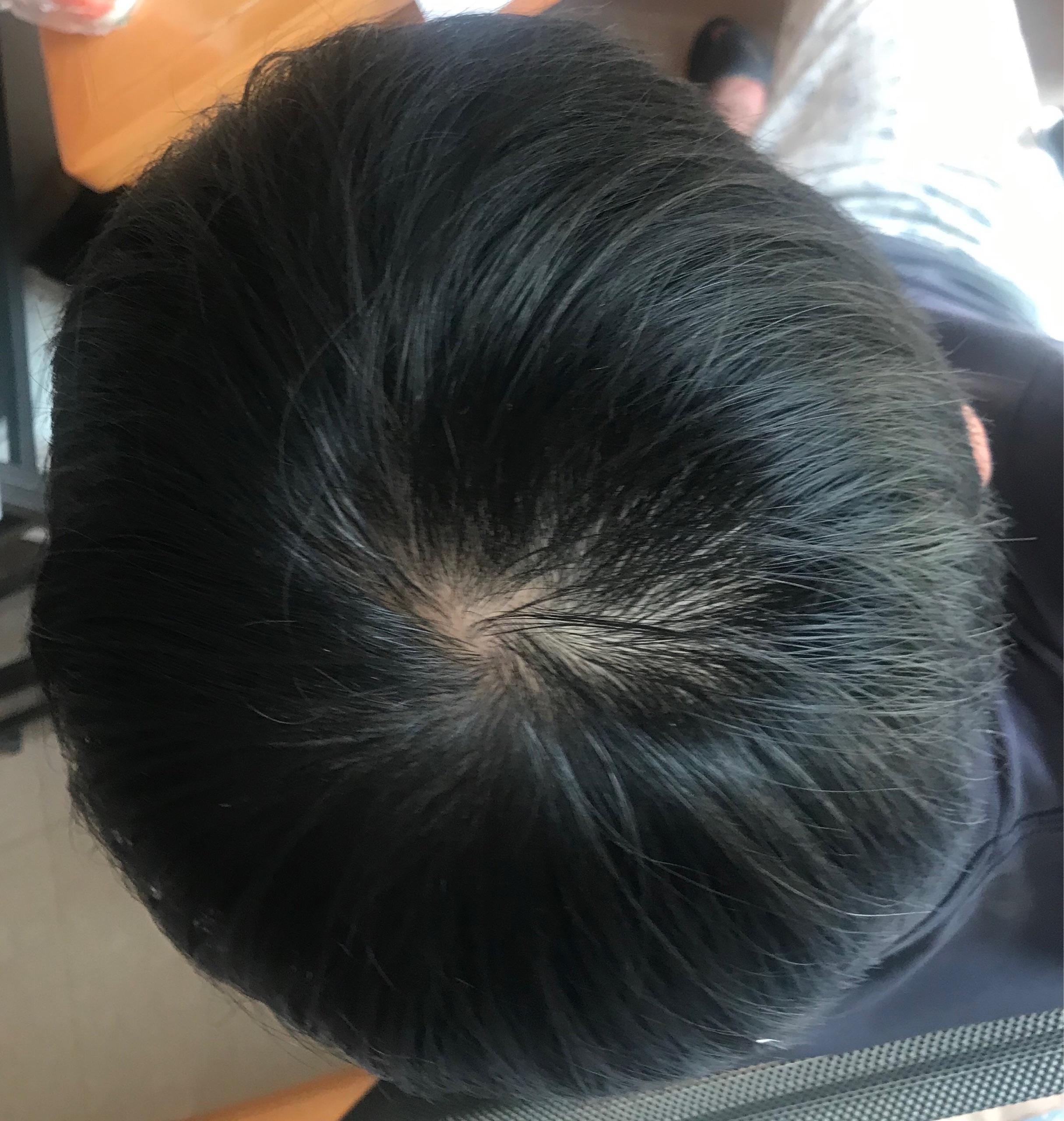 頭頂頭發(fā)稀疏怎么恢復(fù)，原因、治療與日常護(hù)理全解析，頭頂頭發(fā)稀疏，恢復(fù)方法、原因解析與日常護(hù)理全攻略