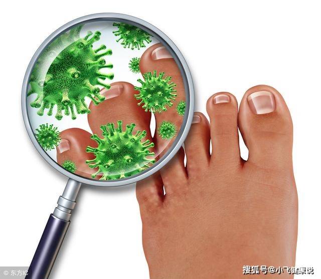 腳氣會留在床單上嗎？深度解析腳氣與床單的關(guān)聯(lián)，深度解析，腳氣是否會留在床單上及其與床單的關(guān)聯(lián)