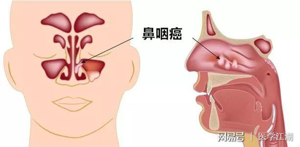 鼻咽癌為什么被稱為幸福癌？解析其背后的原因，鼻咽癌為何被稱為‘幸福癌’？深度解析其背后的原因