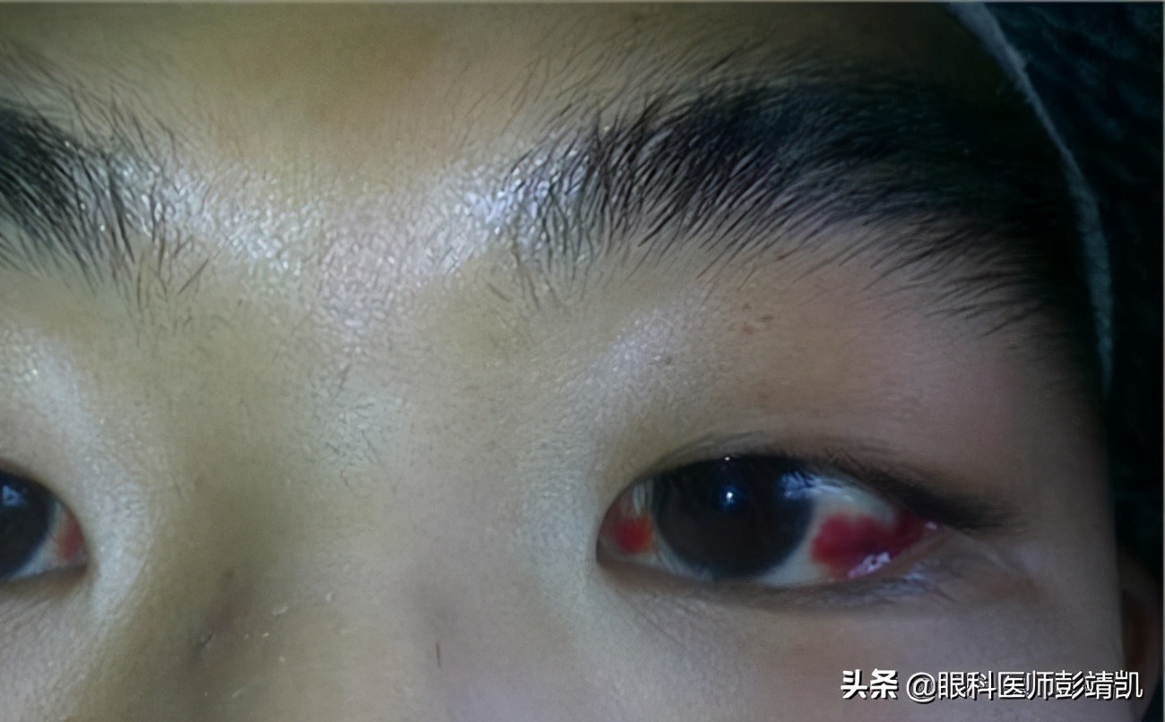 眼球發(fā)紅充血的原因及應(yīng)對(duì)措施，眼球發(fā)紅充血，原因解析與應(yīng)對(duì)策略