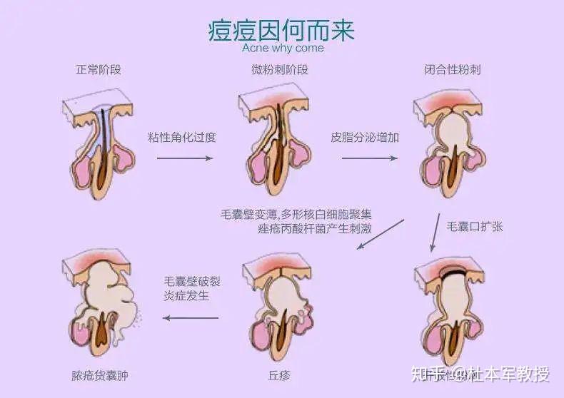關(guān)于痤瘡激光治療的價(jià)格，你需要知道的一切，痤瘡激光治療價(jià)格全解析，你需要知道的一切